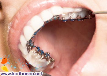 ارتودنسی داخل دندان