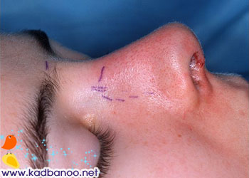 دانستنی هایی درباره جراحی بینی